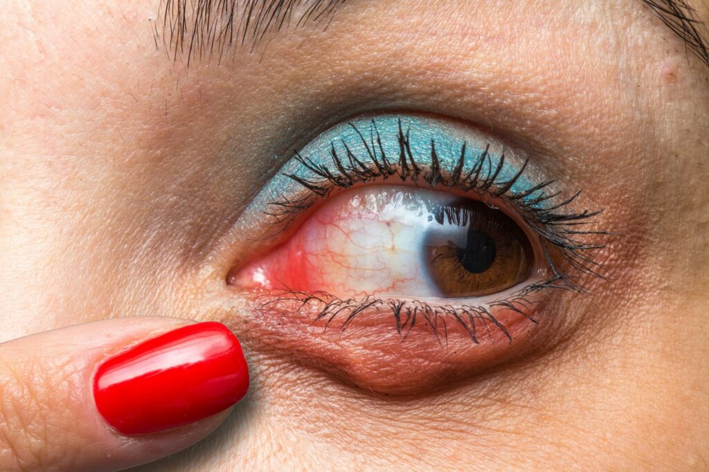 Red eye with chalazion and a finger indicating it