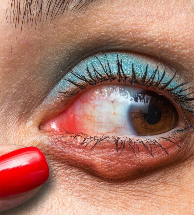 Red eye with chalazion and a finger indicating it
